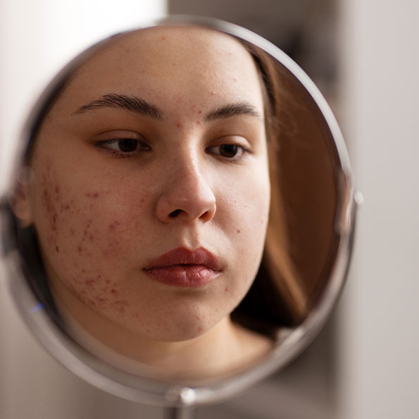 Acneic skin routine